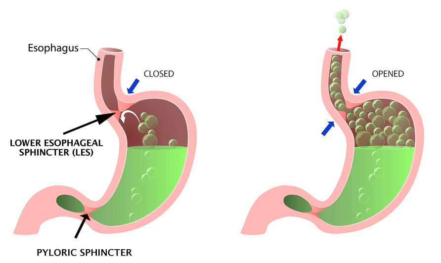 Hypochlorhydria Symptoms, Causes & Tips Nutrition by Erin